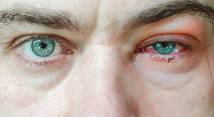 Beyond the Irritation: Long-Term Strategies for Itchy Eye Relief